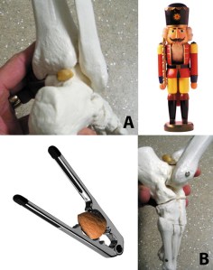 1coverstory-Figure-4-Os-Trigonum