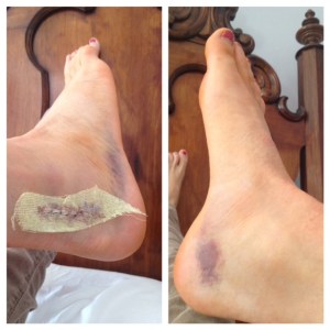 72 hours post op, I was allowed to take the dressing off and shower.  